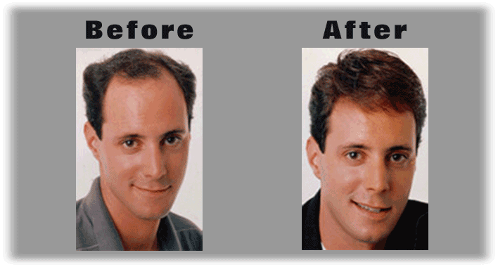 toupee before and after