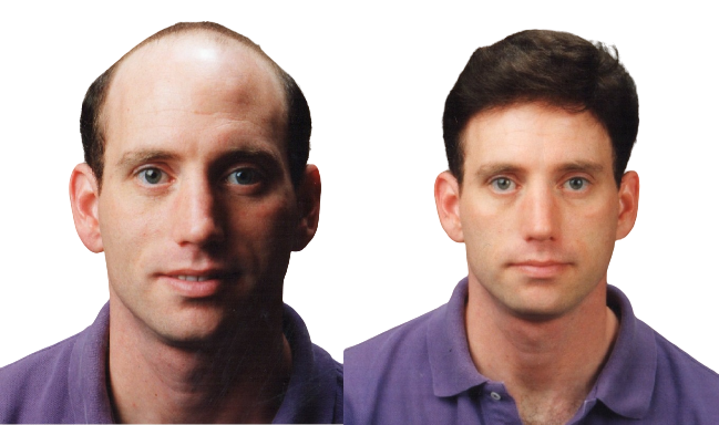 slidee patrick befor and after age 27